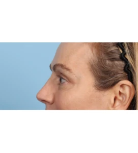 Upper Blepharoplasty 8 A