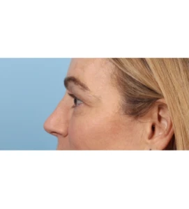 Upper Blepharoplasty 8 B