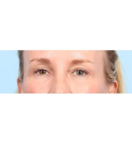 Upper Blepharoplasty 9 A
