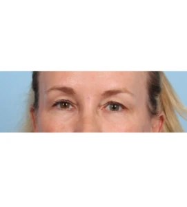 Upper Blepharoplasty 9 B