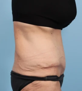 Abdominoplasty 1-1 A