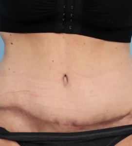 Abdominoplasty 1-1 B