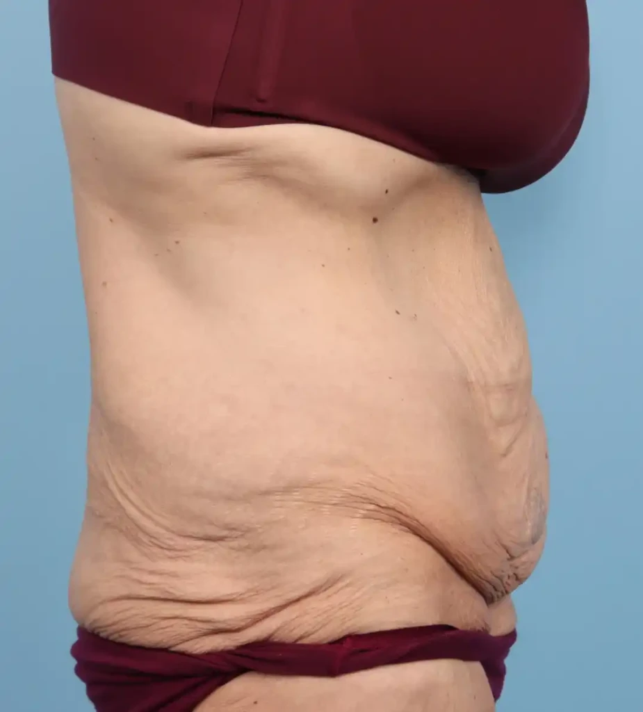 Abdominoplasty 1 A