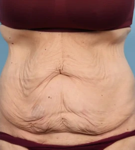 Abdominoplasty 1 b