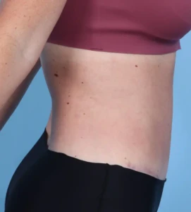 Abdominoplasty 2-1 A