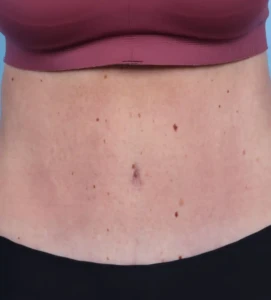 Abdominoplasty 2-1 B