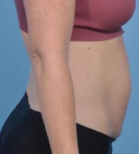 Abdominoplasty 2 A