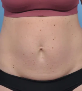 Abdominoplasty 2 B