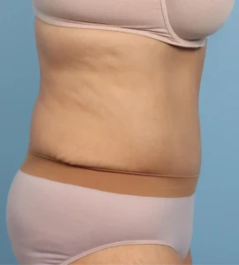 Abdominoplasty 3-1 A
