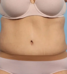 Abdominoplasty 3-1 B