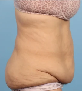Abdominoplasty 3 A