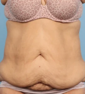 Abdominoplasty 3 B